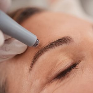 Aplicación tópica de exosomas mediante microneedling en Oneskin-MED