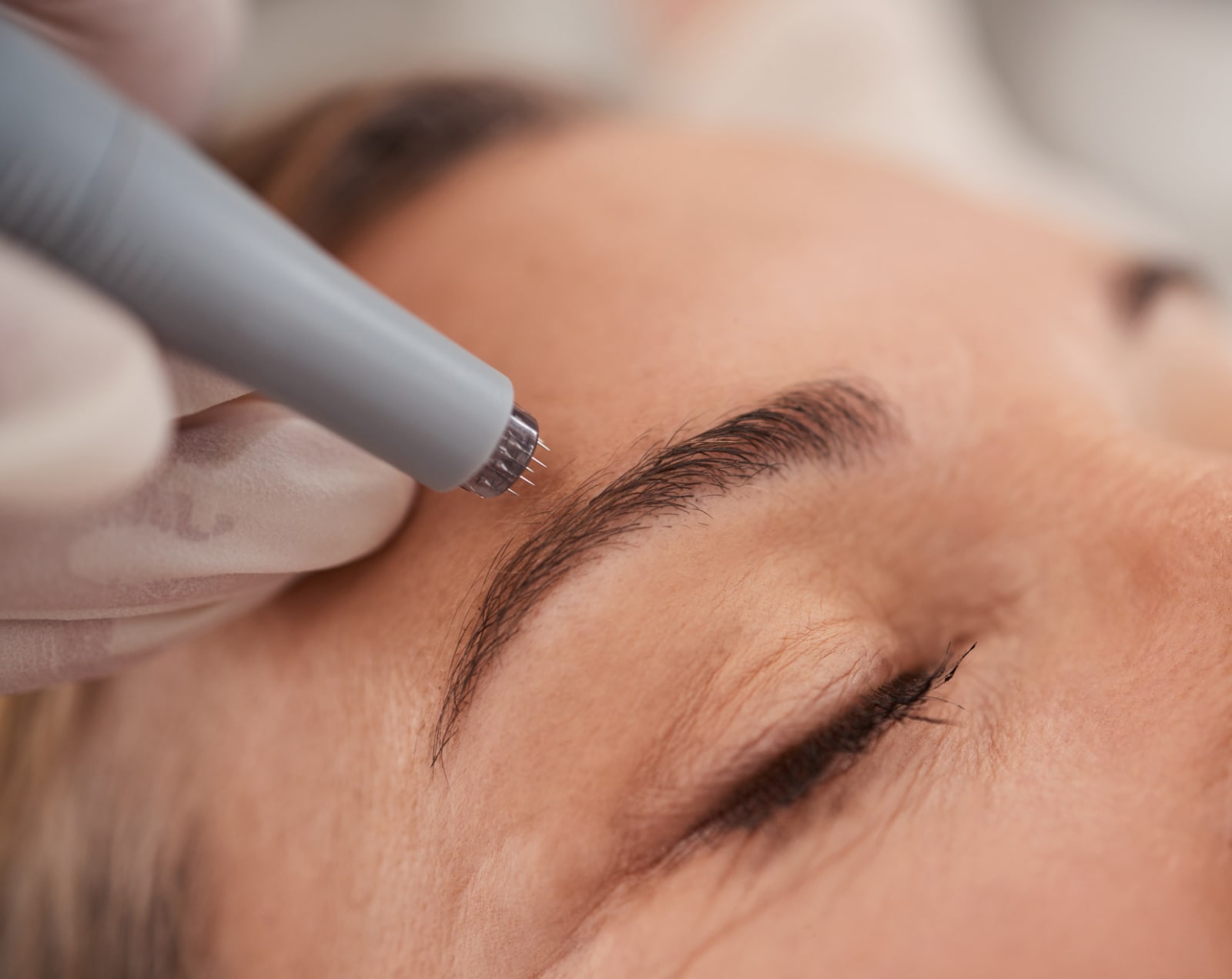 Aplicación tópica de exosomas mediante microneedling en Oneskin-MED